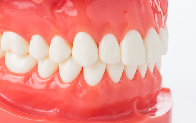 What are Veneers in Turkey?