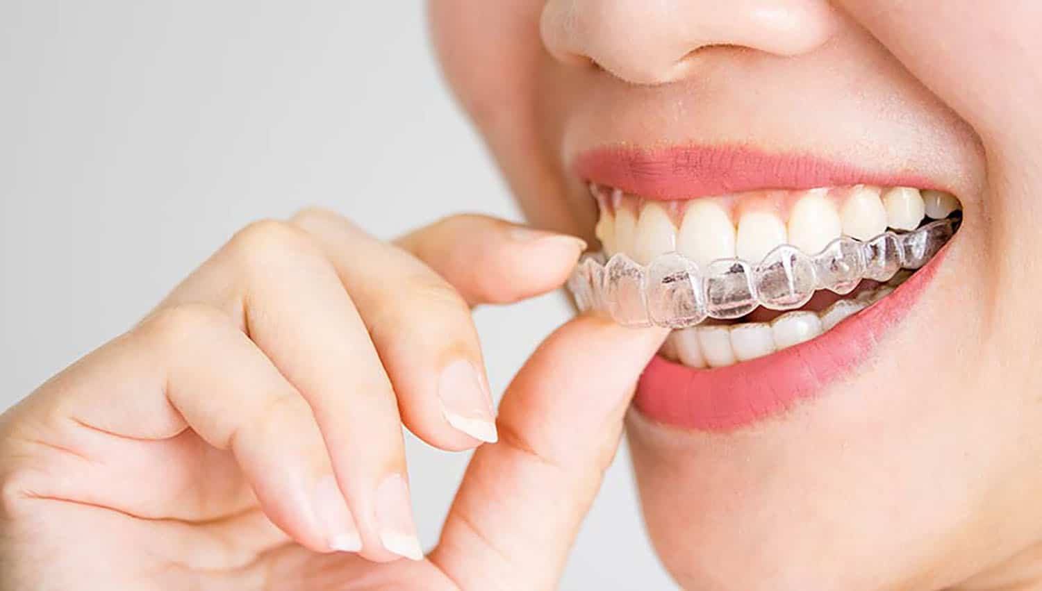 What is invisalign?