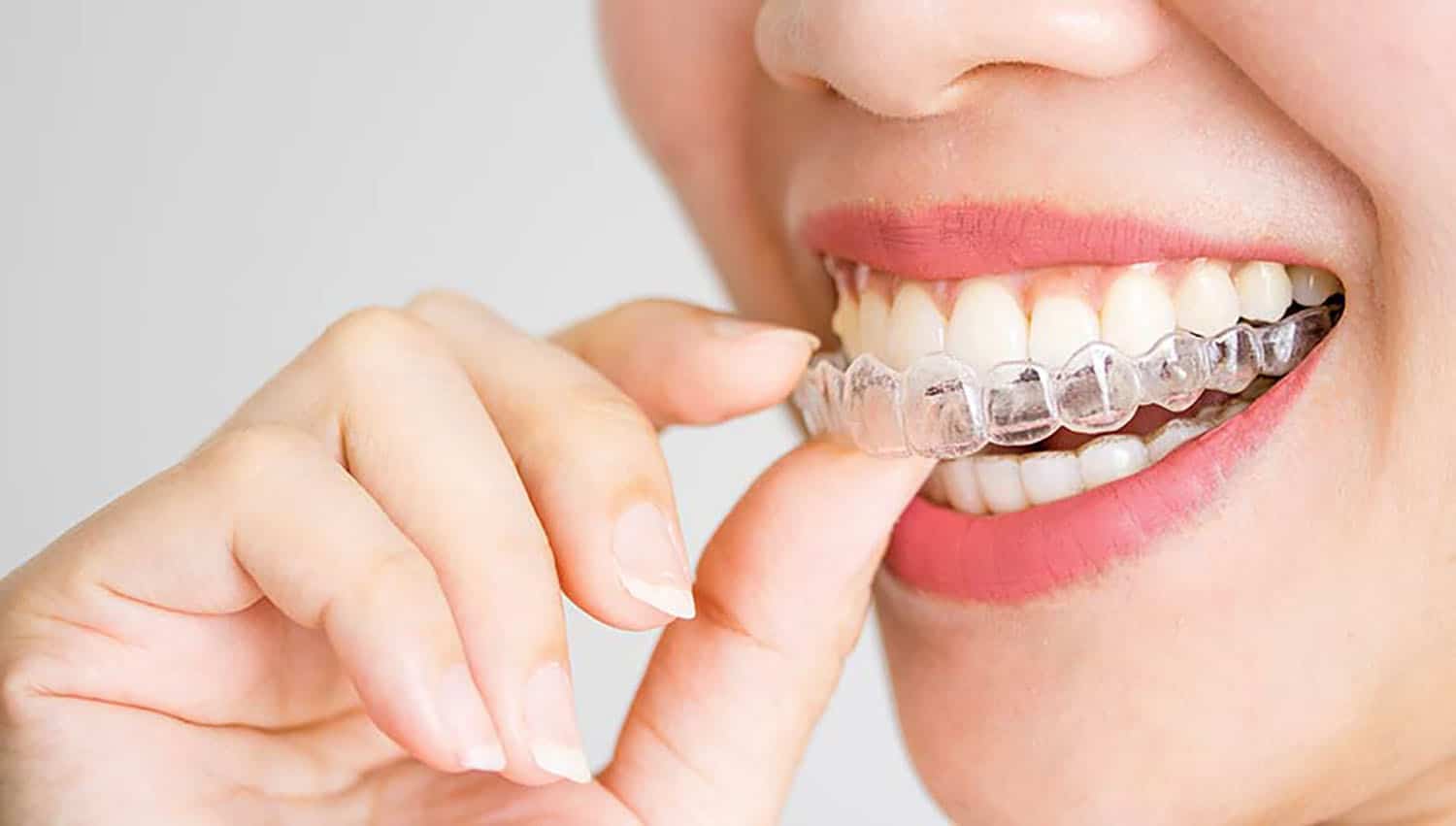 What is invisalign?