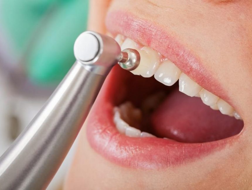 What Are The Side Effects of Teeth Cleanings?