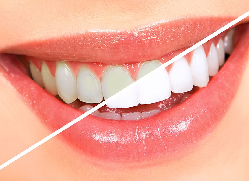 Teeth Whitening Bodrum
