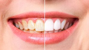 Teeth Whitening Bodrum