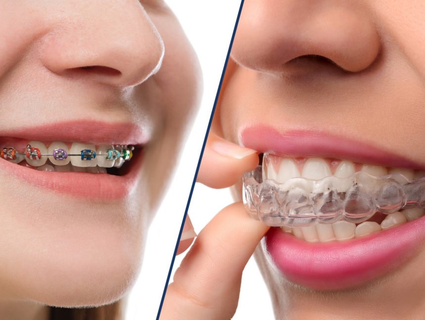 Invisalign vs Braces Which is better for you