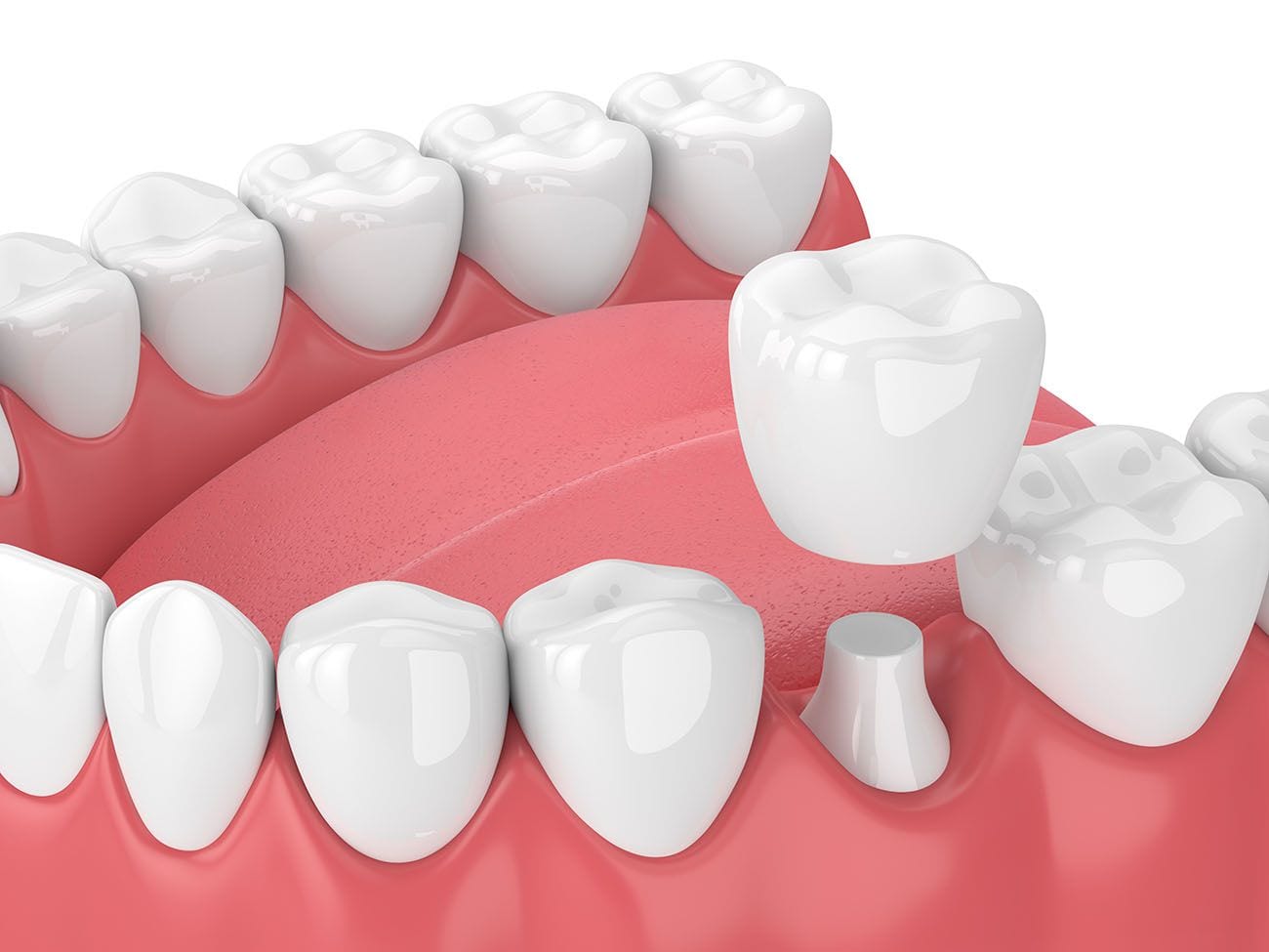 Advantages of Zirconia Crowns