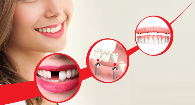 Missing Teeth Treatment